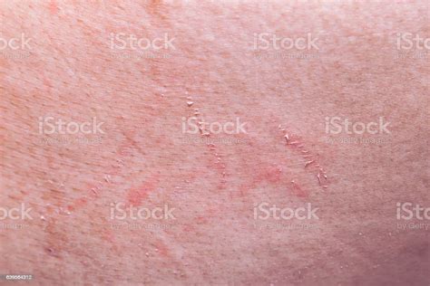 Abrasion Wound On The Skin From Scratching Stock Photo Download Image