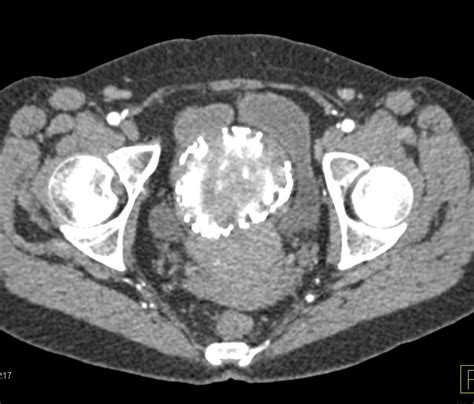 Calcified Uterine Fibroids Obgyn Case Studies Ctisus Ct Scanning