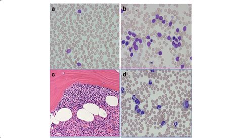 Bone Marrow And Peripheral Blood Smear In 2012 Consistent With A