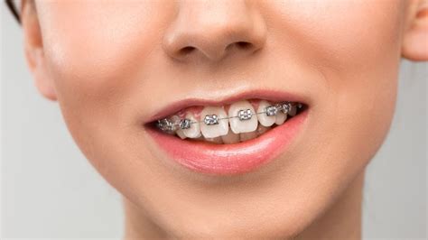 Dente Entramelado Infantil - accentstory