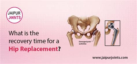 Recovery Time For A Hip Replacement Jaipurjoints Clinic