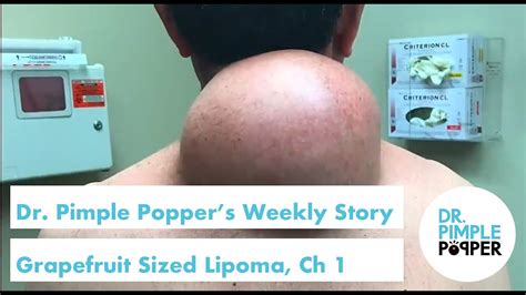 Dr Pimple Poppers Weekly Story Grapefruit Sized Lipoma Chapter 1