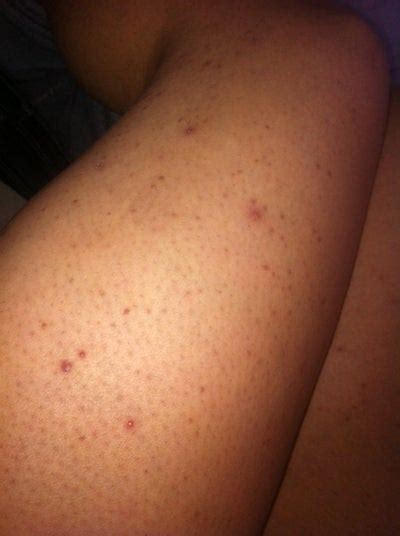 Baby legs with flaky skin. What are the dark spots on my legs? (Photo) Doctor Answers ...