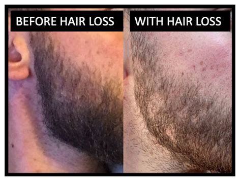 What Is Causing My Beard Body And Scalp Hair Loss — Donovan Hair Clinic