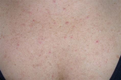 Fungal Acne 101 What It Is How Its Different From A Regular Breakout