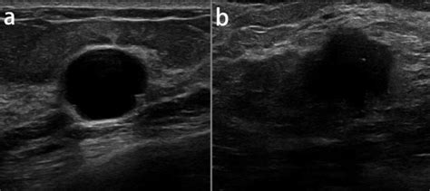 The Samples Of Benign A And Malignant B Lesions In Breast