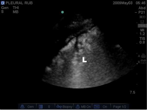 Lung Ultrasound Image Illustrating Lung Consolidation Highlighted By