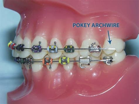 Bales Orthodontics What Should You Do With A Poking Wire With Braces