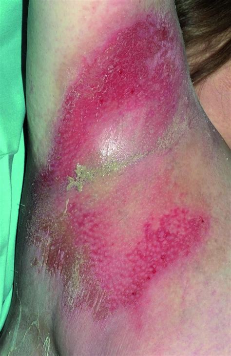 Scalded Skin Syndrome Staphylococcal Scalded Skin