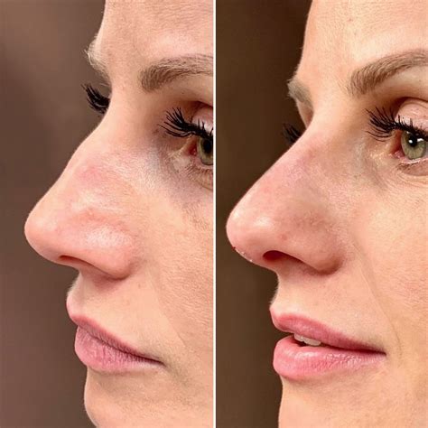 Non Surgical Nose Job In Nyc Rhinoplasty For Men And Women In