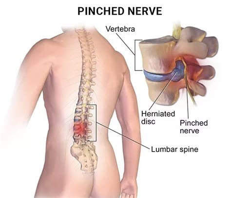 5 Common Symptoms Of A Pinched Nerve Njs Top Orthopedic Spine And Pain