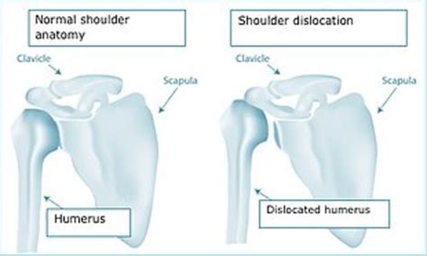 Shoulder Dislocation And Instability Surrey Orthopaedic Clinic