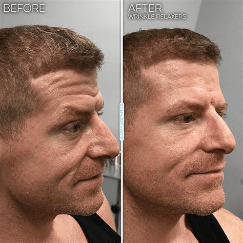 Almost everyone is a good candidate for glabellar botulinum toxin in general though, some of the major things to do before your botox brow lift might include Wrinkle Reduction | Juvly Aesthetics