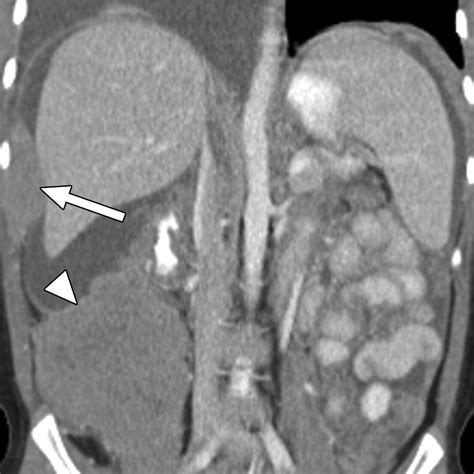 Childhood Burkitt Lymphoma Abdominal And Pelvic Imaging Findings Ajr