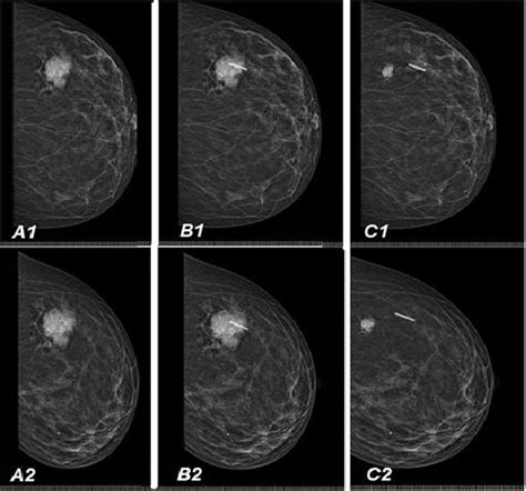A Female Patient 53 Years Old Presented With Left Breast Upper Outer