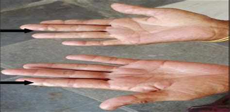 Hand Foot Skin Reaction With Multikinase Inhibitor Sorafenib