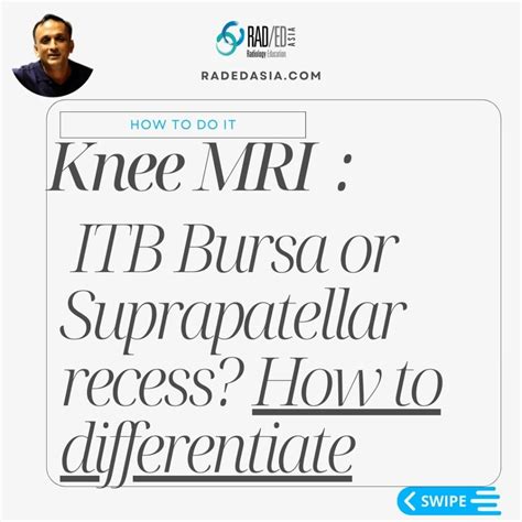 Itb Iliotibial Band Friction Syndrome Mri Is It A Bursa Or A Recess