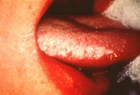 Leukoplakia, or white and gray patches inside the mouth, may be caused by irritation. Hairy Leukoplakia - Pictures, Symptoms, Causes, Diagnosis ...