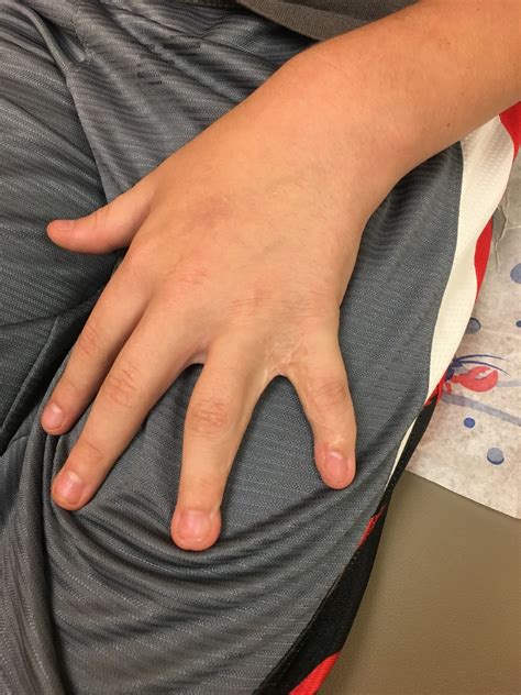 Syndactyly Revision Surgery Congenital Hand And Arm Differences
