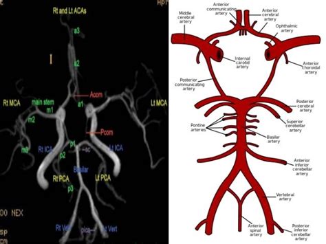 Brain Vascular Anatomy With Mra And Mri Correlation