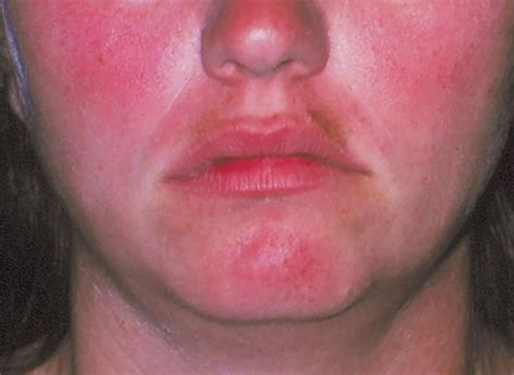 6 Rosacea Treatments That Can Help End Redness The Healthy