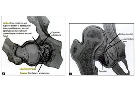 Developmental Dysplasia Of The Hip Pediatrics Orthobullets