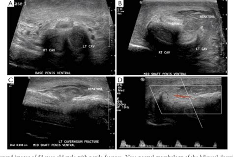 Penile Fracture Role Of Ultrasound Semantic Scholar
