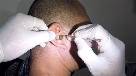 Mans Massive Earwax Removed From His Ear Youtube