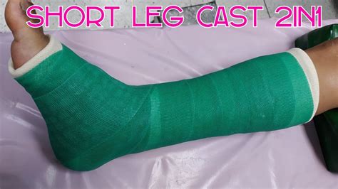 Short Leg Cast 2in1 Case Fxcalcaneous Youtube