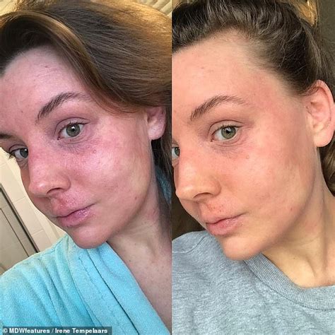 Woman Left With Horrific Steroid Withdrawal Syndrome From Eczema