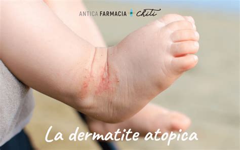 La Dermatite Atopica Cos E Come Curarla