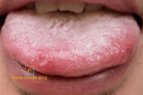 Oral Thrush Symptoms Causes And Treatment Prime Health Blog