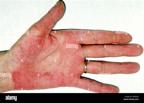 Palmar Erythema Is A Reddening Of The Palms Of The Hands Stock Photo