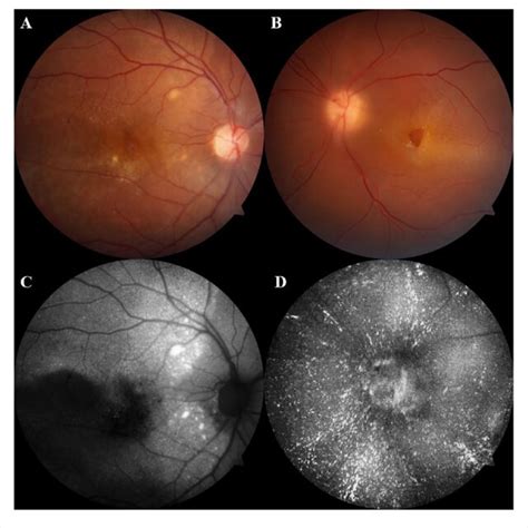 Fundus Photography Of The A Right Eye And B Left Eye Shows The