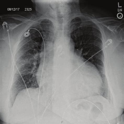 Posterior Anterior Chest X Ray Showing Enlarged Cardiac Silhouette And