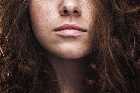 Freckles Causes Identification And Risks