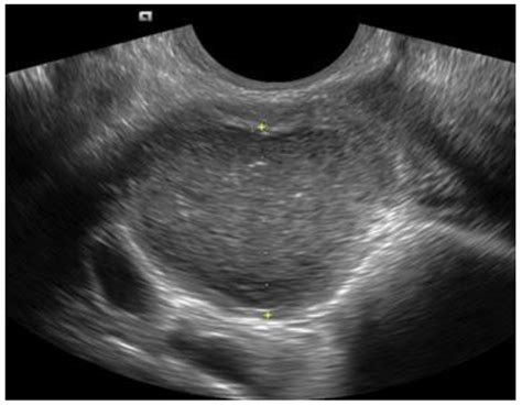 Normal Uterus Transvaginal Ultrasound