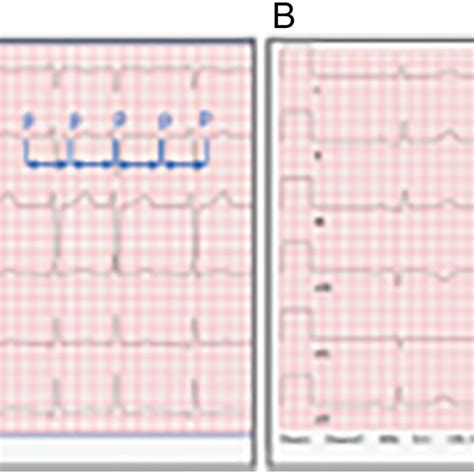 A Patients 12 Lead Electrocardiogram Showing Ectopic Atrial