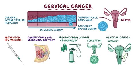 Cervical Cancer Video Anatomy Definition And Function Osmosis