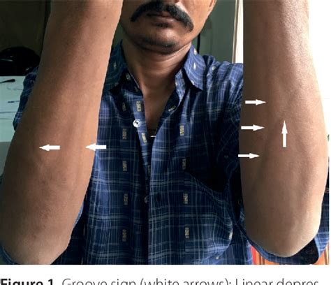 Figure 1 From Groove Sign Heeding Clue To Eosinophilic Fasciitis