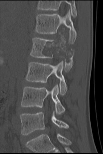 Lumbar Spine Ct Scan Purpose Procedure Risks Gambaran