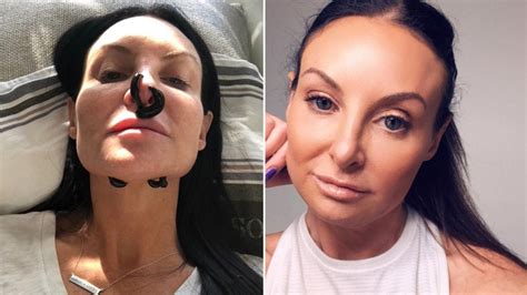 Plastic Surgery Destroyed My Nose But I Fixed It With Leeches Video The Courier Mail
