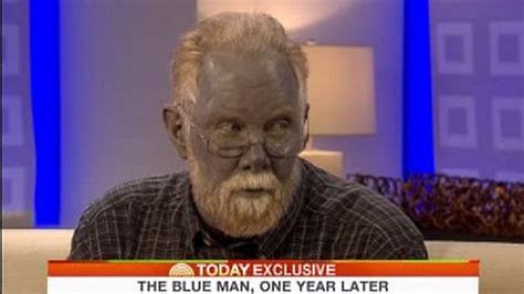 Real Life Blue Man Paul Karason Dies Aged 62 Turned Blue After