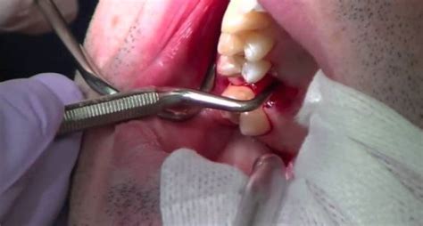 Cavitation And Wisdom Tooth Removal F64