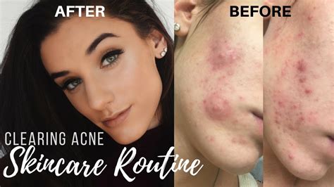 Clearing Up Acne My Skin Care Routine Kelseyg Youtube