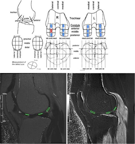Evaluation Of Focal Cartilage Lesions Of The Knee Using Mri T2 Mapping