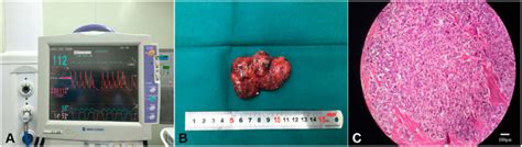 A During The Operation For Adrenal Pheochromocytoma The Blood