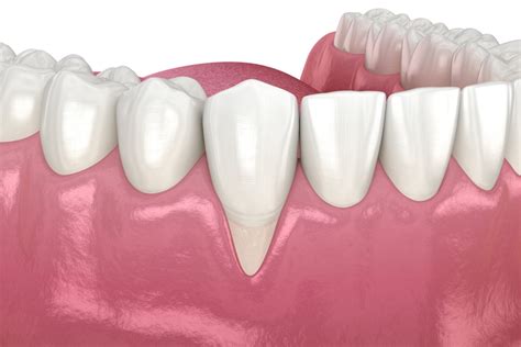 Gum Recession Treatment Advanced Implants Periodontics