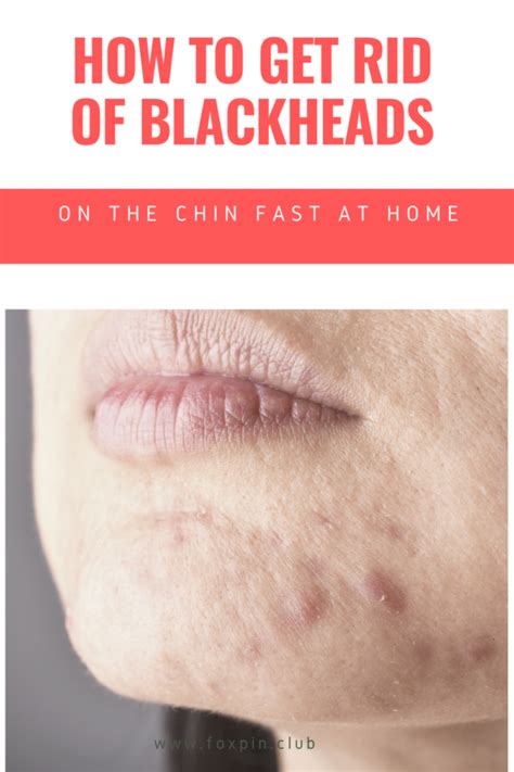How To Get Rid Of Blackheads On The Chin Fast At Home Weight Loss