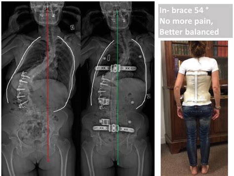 Bracing Adult Scoliosis From Immobilization To Correction Of Adult